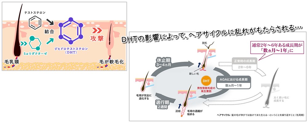 男性型脱毛症（AGA）のメカニズム